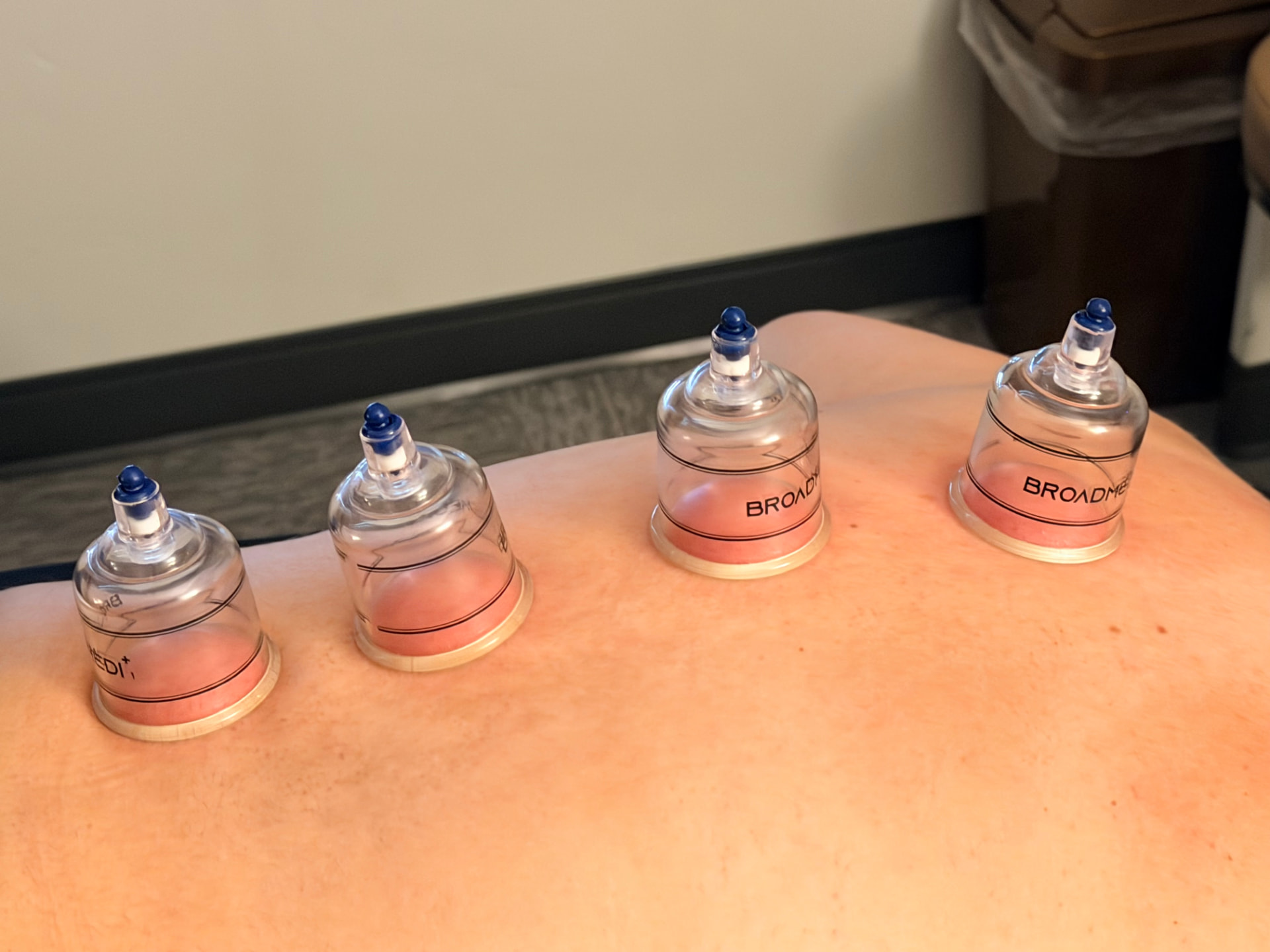 Cupping therapy applied across a patient's upper back at Point Chiropractic